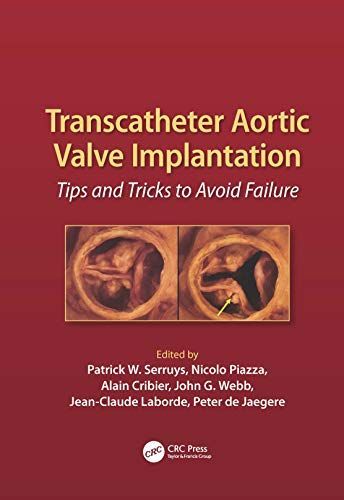 Transcatheter Aortic Valve Implantation