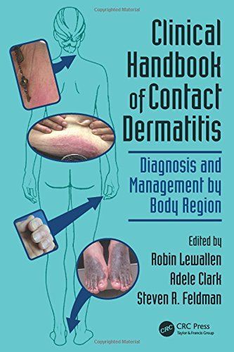 Clinical Handbook of Contact Dermatitis